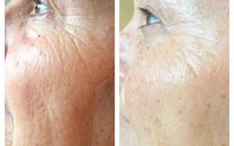 Résultats après 3 sessions d'électroporation (les résultats varient selon les personnes et les zones traitées et ne peuvent donc pas être garantis)