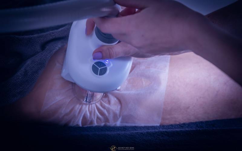 Cryolipolyse : installation sur la zone