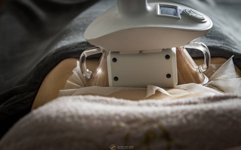 Cryolipolyse du ventre à Balma, proche de Toulouse